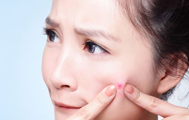 5 Easy Ways To Prevent Pimples